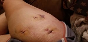 What my leg looked after surgery that was needed after Anthony Fasano attacked me